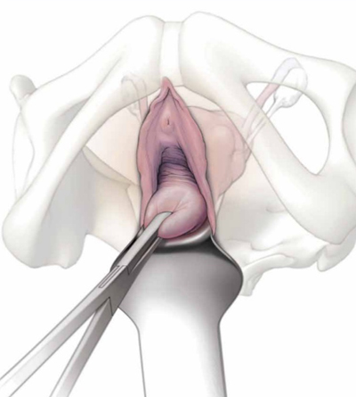 Non Descent Vaginal Hysterectomy