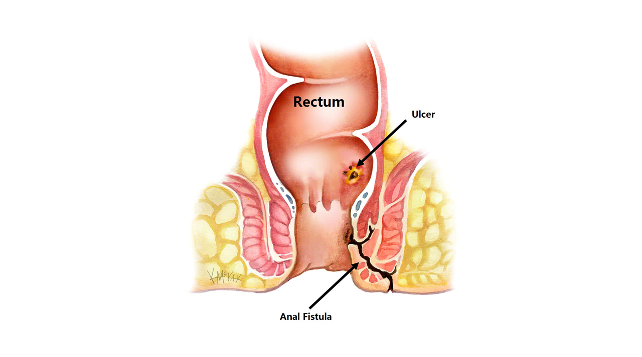 Anorectal Surgery